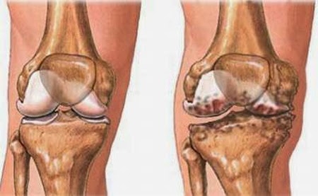 Chondrocalcinose - Hình ảnh minh họa